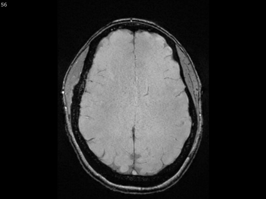 Atypical meningioma - intraosseous (Radiopaedia 64915-74572 Axial SWI 56).jpg