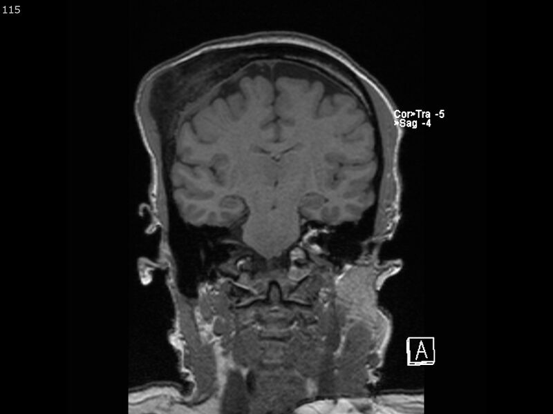 File:Atypical meningioma - intraosseous (Radiopaedia 64915-74572 Coronal T1 115).jpg