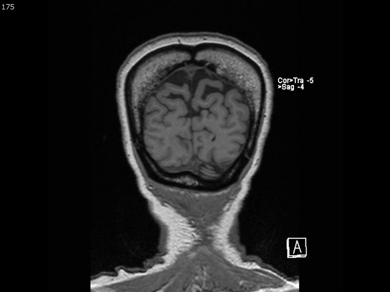 File:Atypical meningioma - intraosseous (Radiopaedia 64915-74572 Coronal T1 175).jpg