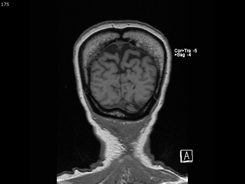 Atypical meningioma - intraosseous (Radiopaedia 64915-74572 Coronal T1 175).jpg