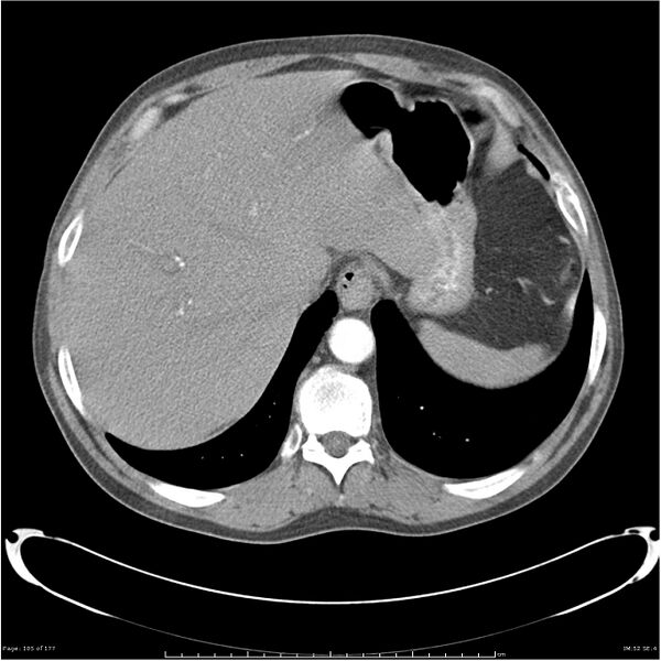 File:Atypical pneumonia - Q fever (Radiopaedia 21993-21989 C+ arterial phase 44).jpg
