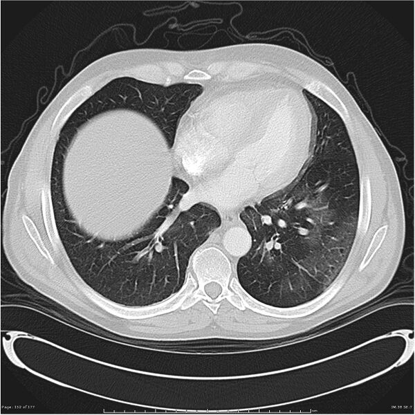 File:Atypical pneumonia - Q fever (Radiopaedia 21993-21989 lung window 31).jpg
