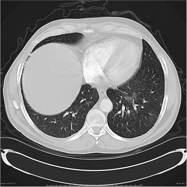 File:Atypical pneumonia - Q fever (Radiopaedia 21993-21989 lung window 35).jpg