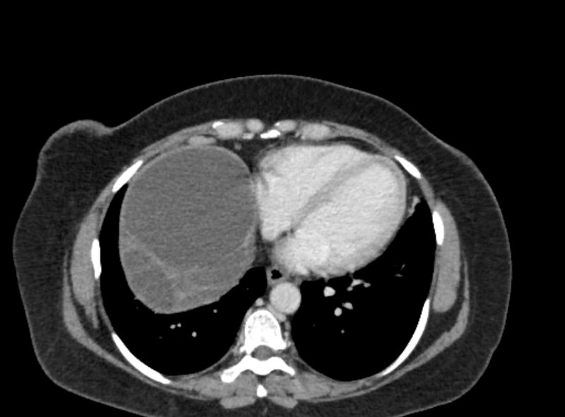 File:Autosomal dominant polycystic kidney disease (Radiopaedia 57124-64017 A 12).jpg