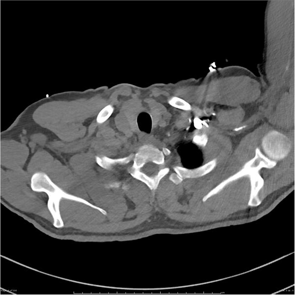 File:Azygos venous system anatomy (CT pulmonary angiography) (Radiopaedia 25928-26077 Axial C+ CTPA 5).jpg
