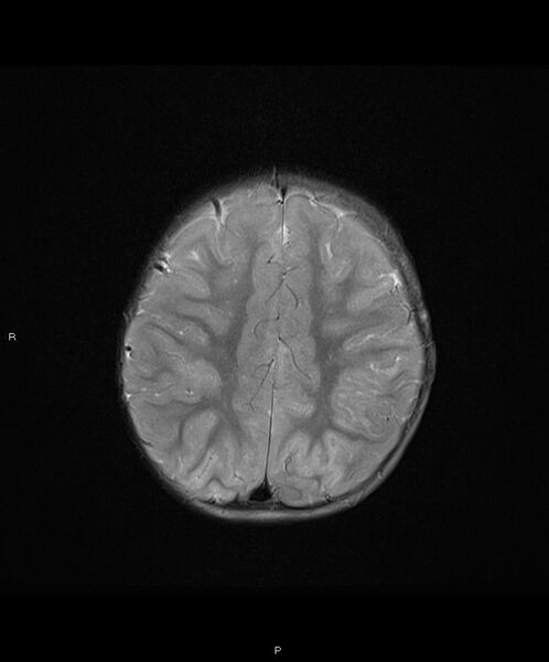 File:Basal ganglia and parenchymal ischemia (Radiopaedia 45818-50084 Axial T2 16).jpg