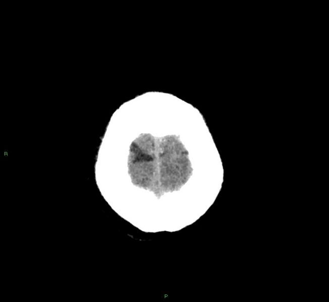 File:Basal ganglia hemorrhage (Radiopaedia 58763-65985 Axial non-contrast 6).jpg
