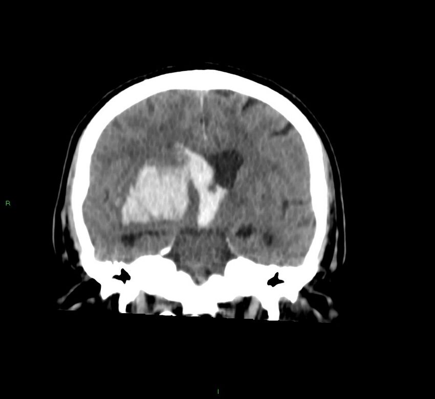 Basal ganglia hemorrhage (Radiopaedia 58763-65985 Coronal non-contrast 39).jpg