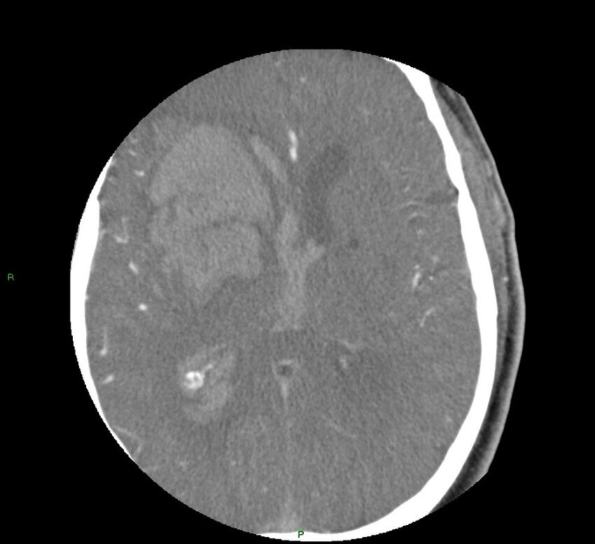 Basal ganglia hemorrhage (Radiopaedia 58763-65985 D 103).jpg