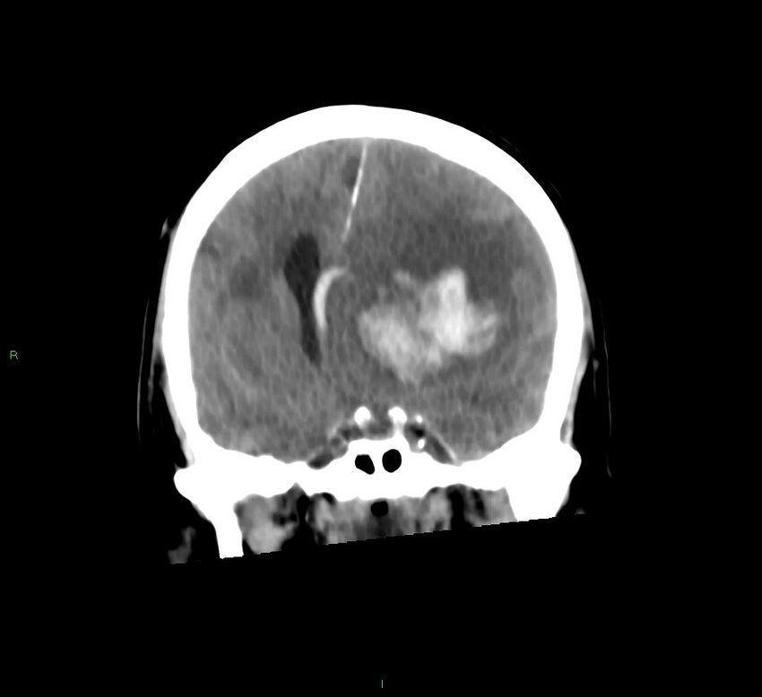 Basal ganglia hemorrhage (Radiopaedia 58775-66008 Coronal non-contrast 40).jpg