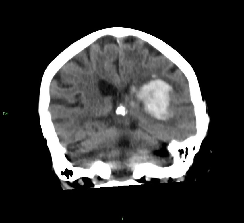 Basal ganglia hemorrhage (Radiopaedia 58790-66024 Coronal non-contrast 24).jpg