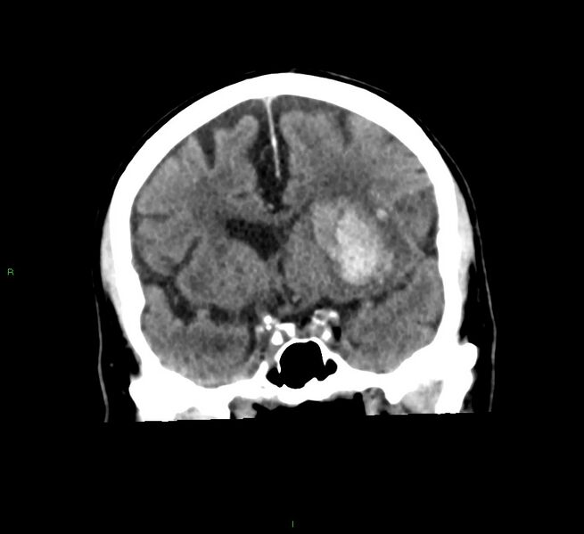 File:Basal ganglia hemorrhage (Radiopaedia 58791-66025 Coronal non-contrast 39).jpg