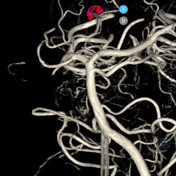 File:Basilar artery perforator aneurysm (Radiopaedia 82455-97734 3D view left VA 34).jpg