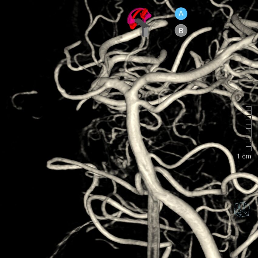 Basilar artery perforator aneurysm (Radiopaedia 82455-97734 3D view left VA 34).jpg
