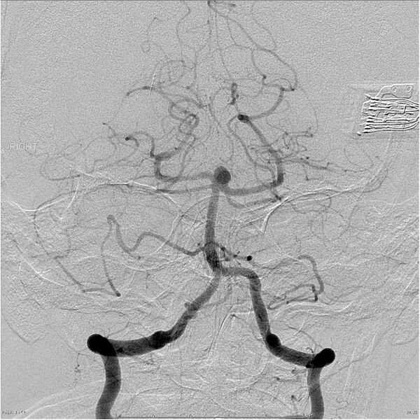 File:Basilar tip aneurysm double balloon remodeling (Radiopaedia 18100-17883 Vertebral artery 1).jpg