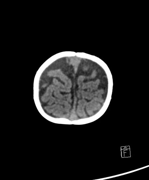 File:Benign enlargement of subarachnoid spaces in infancy (BESS) (Radiopaedia 87459-103795 Axial non-contrast 9).jpg