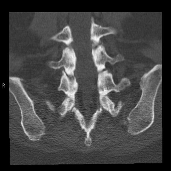File:Bertolotti syndrome (Radiopaedia 24864-25128 Coronal bone window 34).jpg