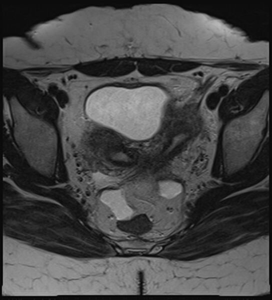 File:Bicornuate, unicollis uterus (Radiopaedia 79468-92593 Axial T2 12).jpg