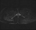 Bicornuate bicollis uterus (Radiopaedia 61626-69616 Axial PD fat sat 36).jpg