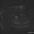 Bicornuate uterus- on MRI (Radiopaedia 49206-54297 Axial DWI 1).jpg