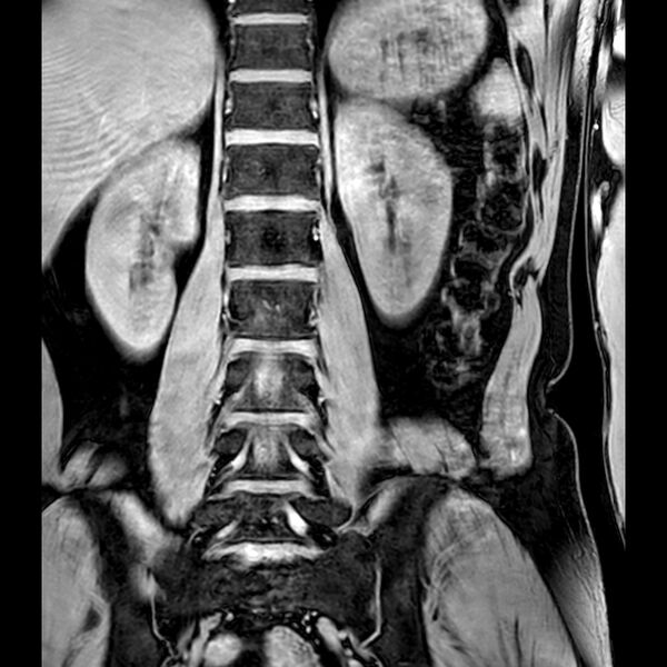 File:Bilateral conjoined nerve roots at different levels (Radiopaedia 73312-84063 B 26).jpg