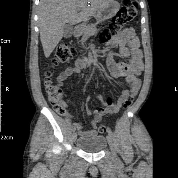 File:Bilateral medullary nephrocalcinosis with ureteric calculi (Radiopaedia 71269-81569 Coronal non-contrast 25).jpg