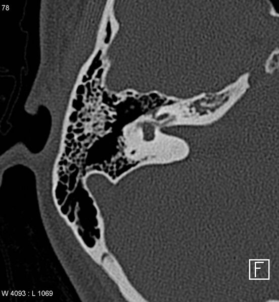 File:Bilateral otosclerosis with left stapes prosthesis (Radiopaedia 5567-7302 Axial bone window 11).jpg