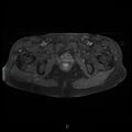 Bilateral ovarian fibroma (Radiopaedia 44568-48293 Axial T1 C+ fat sat 25).jpg