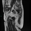 Bilateral ovarian fibroma (Radiopaedia 44568-48293 Sagittal T2 27).jpg
