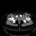 Bilateral ovarian mature cystic teratomas (Radiopaedia 79373-92457 Axial non-contrast 93).jpg
