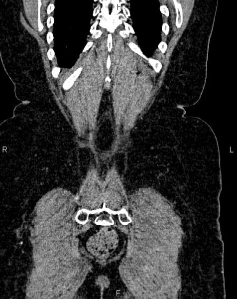 File:Bilateral ovarian serous cystadenocarcinoma (Radiopaedia 86062-101989 D 51).jpg