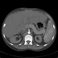 Biliary necrosis - liver transplant (Radiopaedia 21876-21846 A 25).jpg
