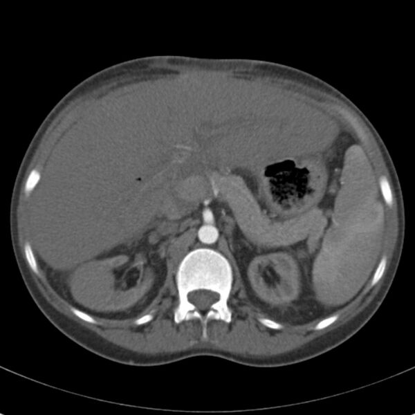File:Biliary necrosis - liver transplant (Radiopaedia 21876-21846 A 25).jpg