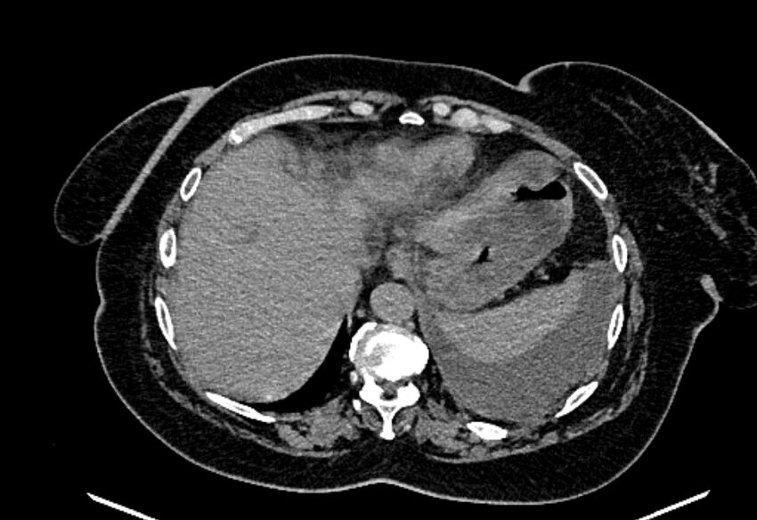 Biliary pancreatitis (Radiopaedia 72289-82823 Axial non-contrast 51).jpg