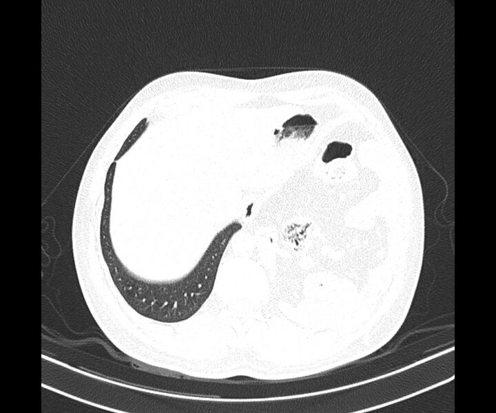 File:Bochdalek hernia - adult presentation (Radiopaedia 74897-85925 Axial lung window 39).jpg