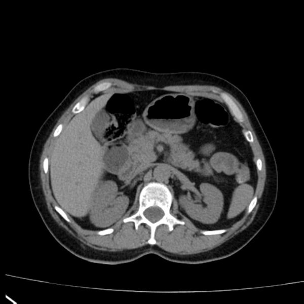 File:Bosniak renal cyst - type I (Radiopaedia 27479-27675 Axial non-contrast 29).jpg