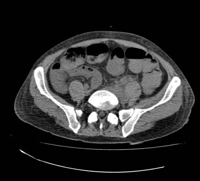 File:Bowel lymphoma complicated by bleeding after therapy (Radiopaedia 55601-62110 Axial non-contrast 59).jpg