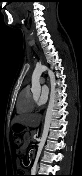 File:Brachiocephalic trunk pseudoaneurysm (Radiopaedia 70978-81191 C 53).jpg