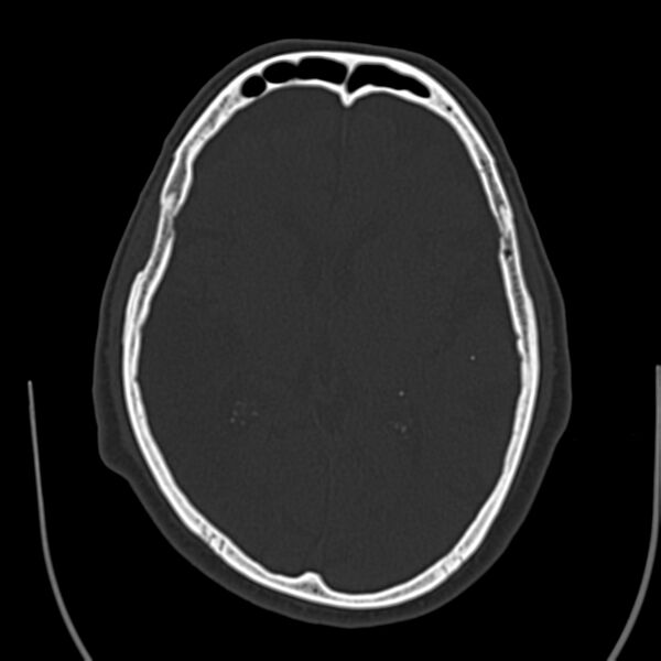 File:Brain Pantopaque remnants (Radiopaedia 78403-91048 Axial bone window 38).jpg