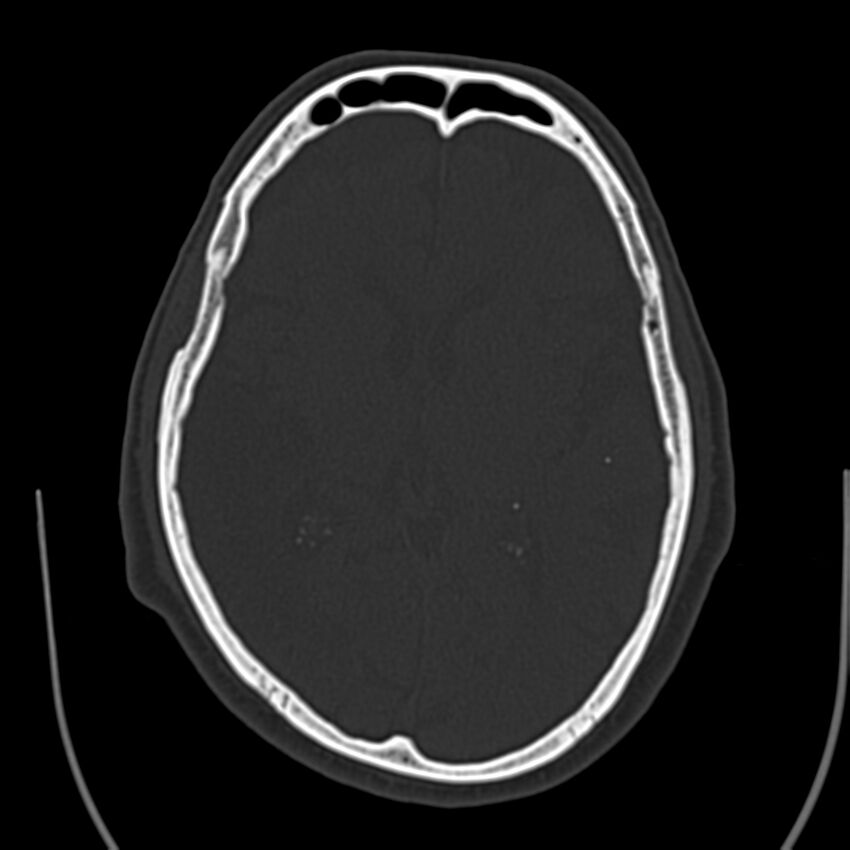 Brain Pantopaque remnants (Radiopaedia 78403-91048 Axial bone window 38).jpg