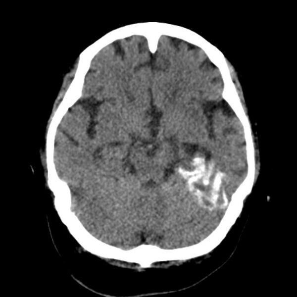 File:Brain cortical laminar necrosis (Radiopaedia 25822-25971 Axial non-contrast 16).jpg