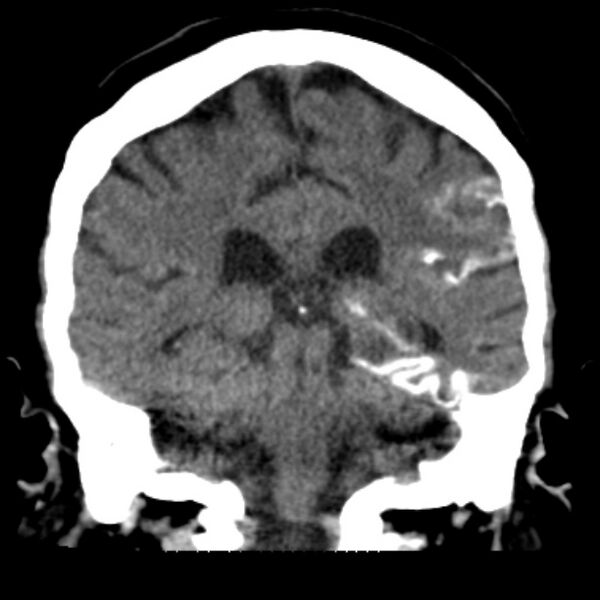 File:Brain cortical laminar necrosis (Radiopaedia 25822-25971 C 35).jpg