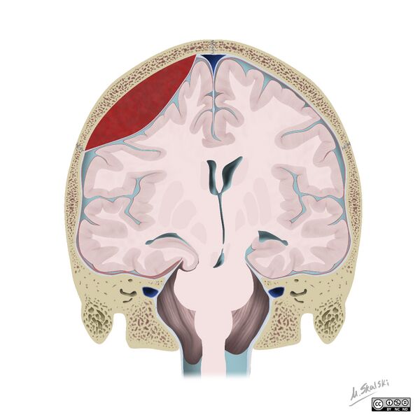 File:Brain herniation types (Radiopaedia 45683-49865 None 1).jpg