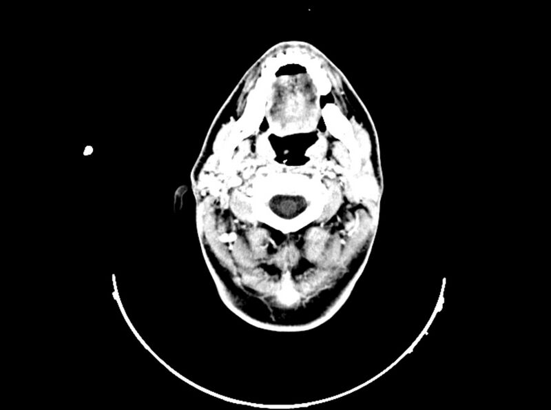File:Brain injury by firearm projectile (Radiopaedia 82068-96088 B 49).jpg