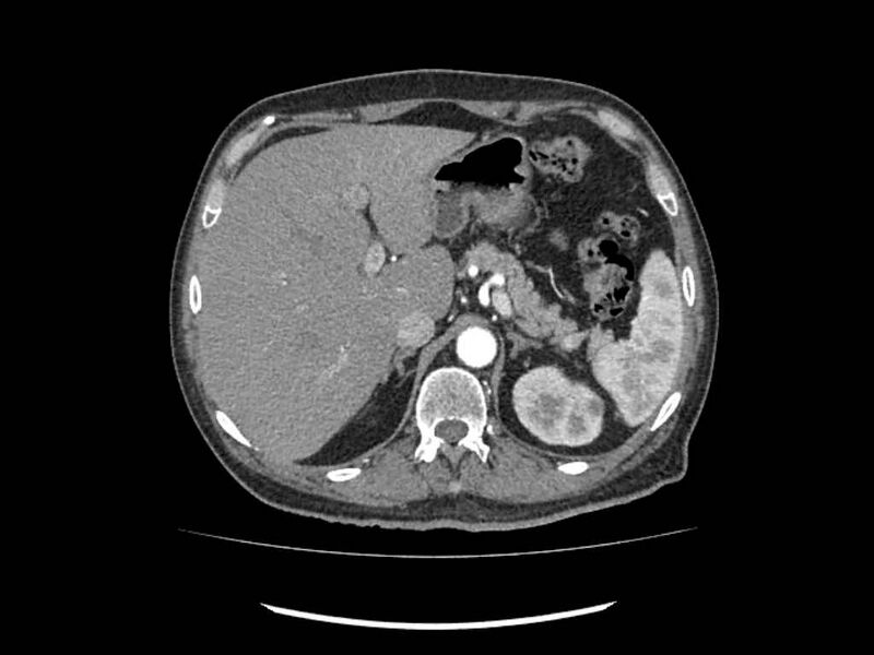 File:Brain metastases from renal cell carcinoma (Radiopaedia 42222-45328 A 15).jpg