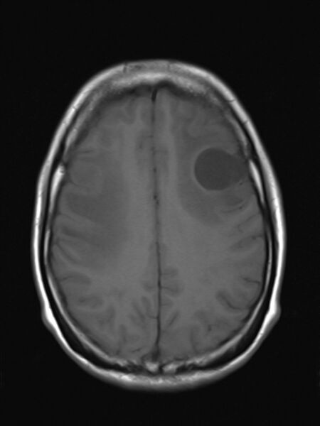 File:Brain metastasis as initial presentation of non-small cell lung cancer (Radiopaedia 65122-74126 Axial T1 14).jpg
