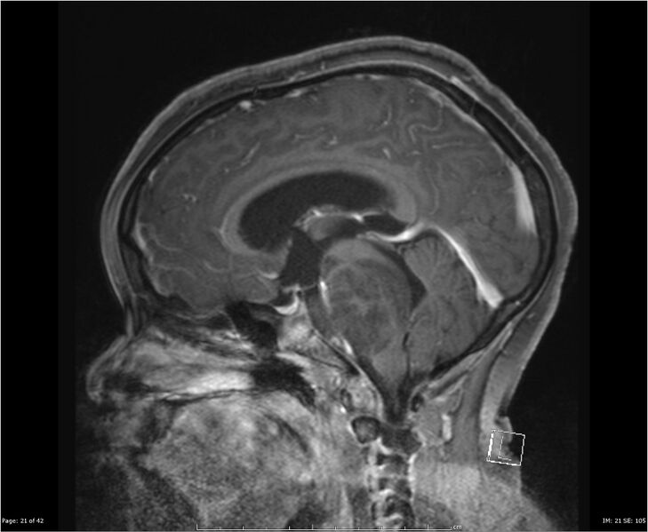 File:Brainstem glioma (Radiopaedia 21819-21775 D 21).jpg