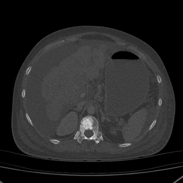 File:Breast cancer metastases - hepatic and skeletal (Radiopaedia 34201-35461 Axial bone window 43).jpg