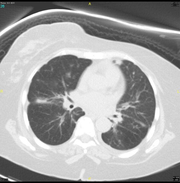 File:Breast primary with lung and bone metastases (Radiopaedia 40620-43228 Axial lung window 26).jpg