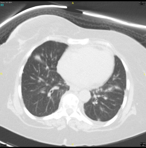 File:Breast primary with lung and bone metastases (Radiopaedia 40620-43228 Axial lung window 33).jpg